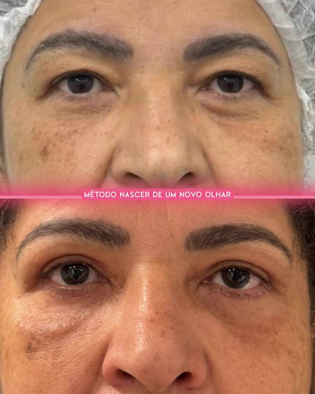 Caso clínico 01 — blefaroplastia conduzida pela Dra. Camila Nogueira Bezerra