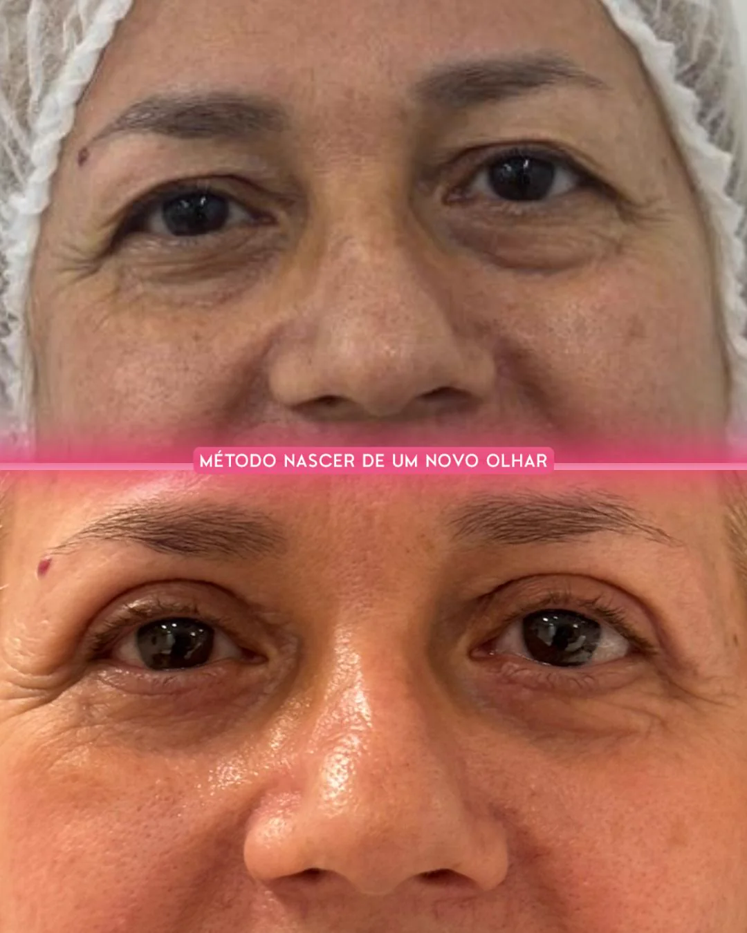 Caso clínico 02 — blefaroplastia conduzida pela Dra. Camila Nogueira Bezerra