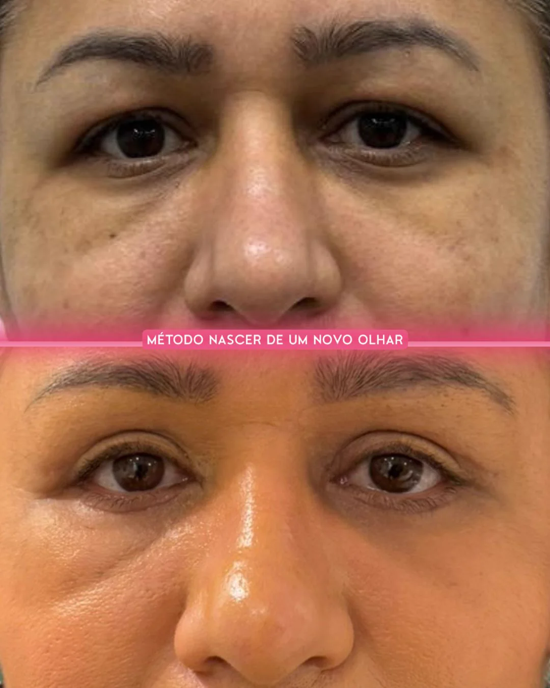 Caso clínico 04 — blefaroplastia conduzida pela Dra. Camila Nogueira Bezerra